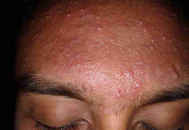 Benefits of Apple Cider Vinegar